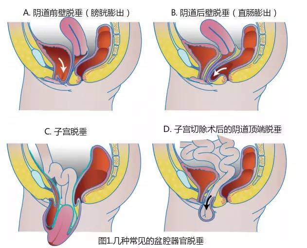 其发病率是阴道后壁脱垂(即直肠膨出)的 2 倍,是阴道顶端脱垂(包括