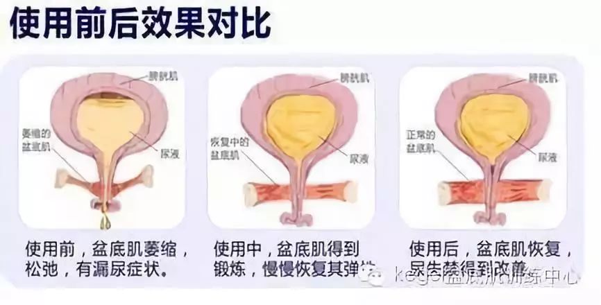 一文带你了解盆底肌康复电刺激疗法的作用原理
